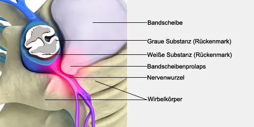 Abbildung zum Artikel: Bandscheibenvorfall verhindern! Gefahr erkennen, und vorbeugen
