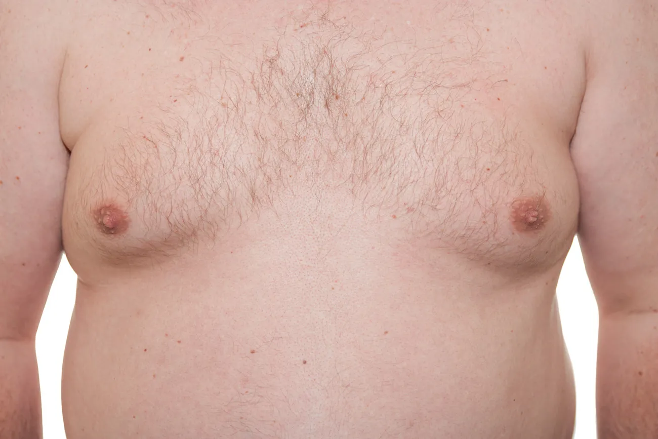 Beitragsbild zum Artikel: Wird Gynäkomastie mit sexueller Dysfunktion in Verbindung gebracht?