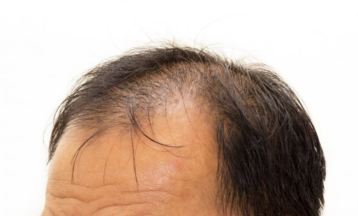 Eine Laserbehandlung könnte das Haarwachstum fördern