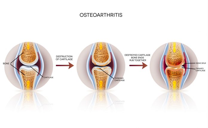 Krafttraining reduziert das Risiko für Osteoarthritis